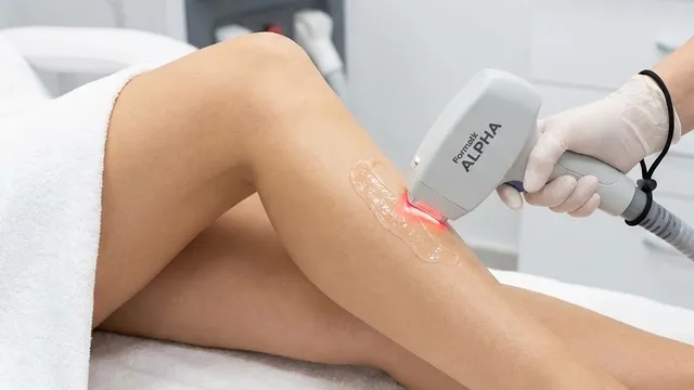 Epilare Definitiva Laser